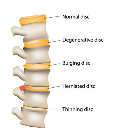degenerativediscdisease degenerativediscdisease