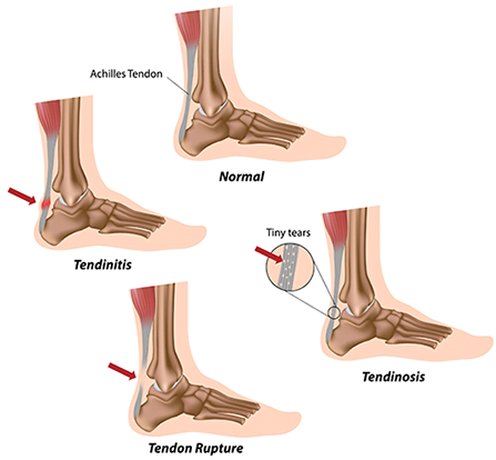 achillestendonitis